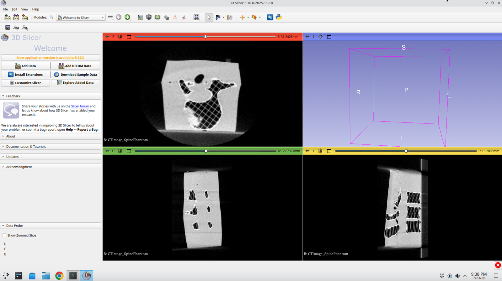 Slicer slice views showing the loaded CT image of the spine phantom