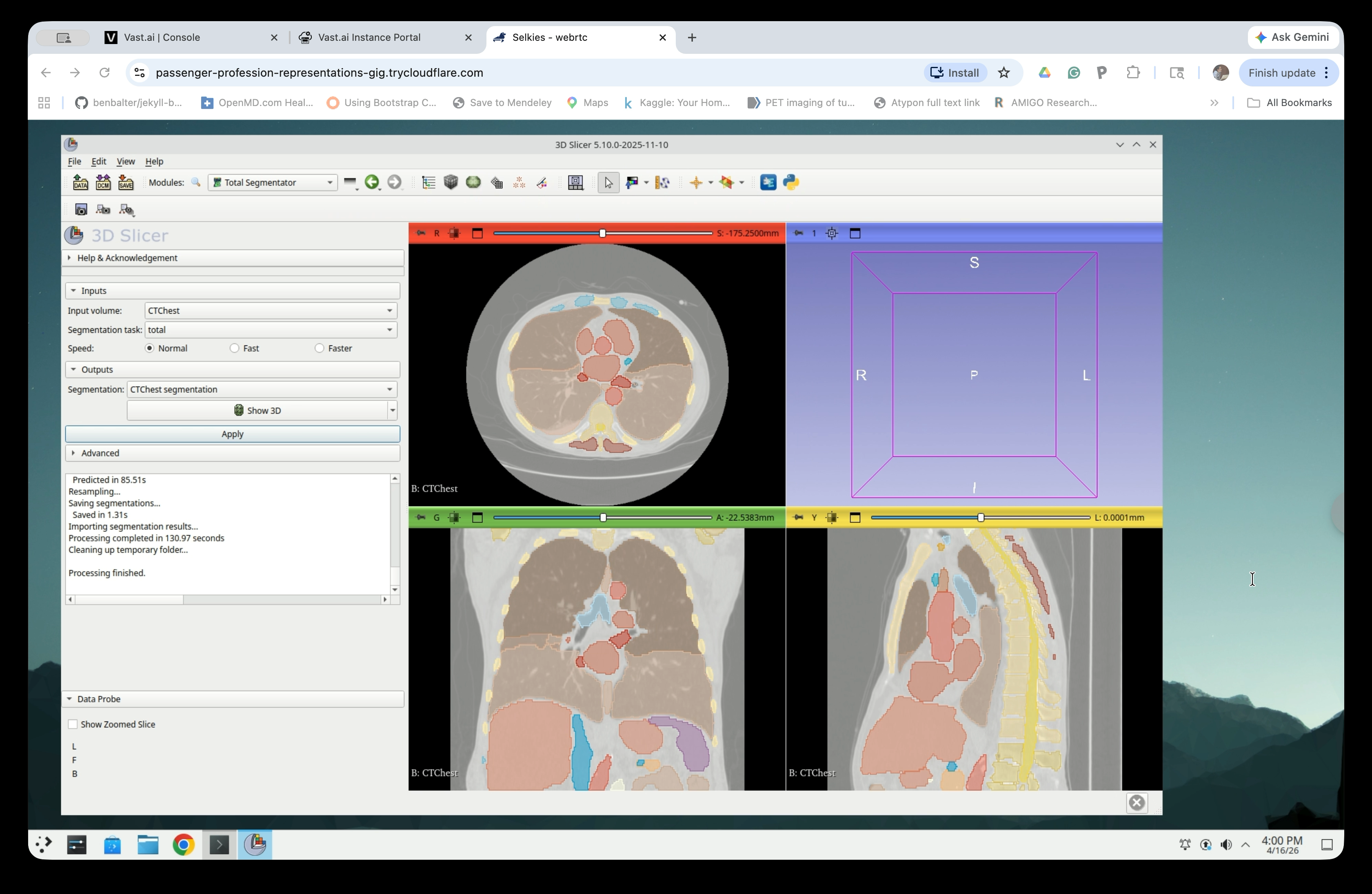 Segmentation complete with colored overlays on slice views