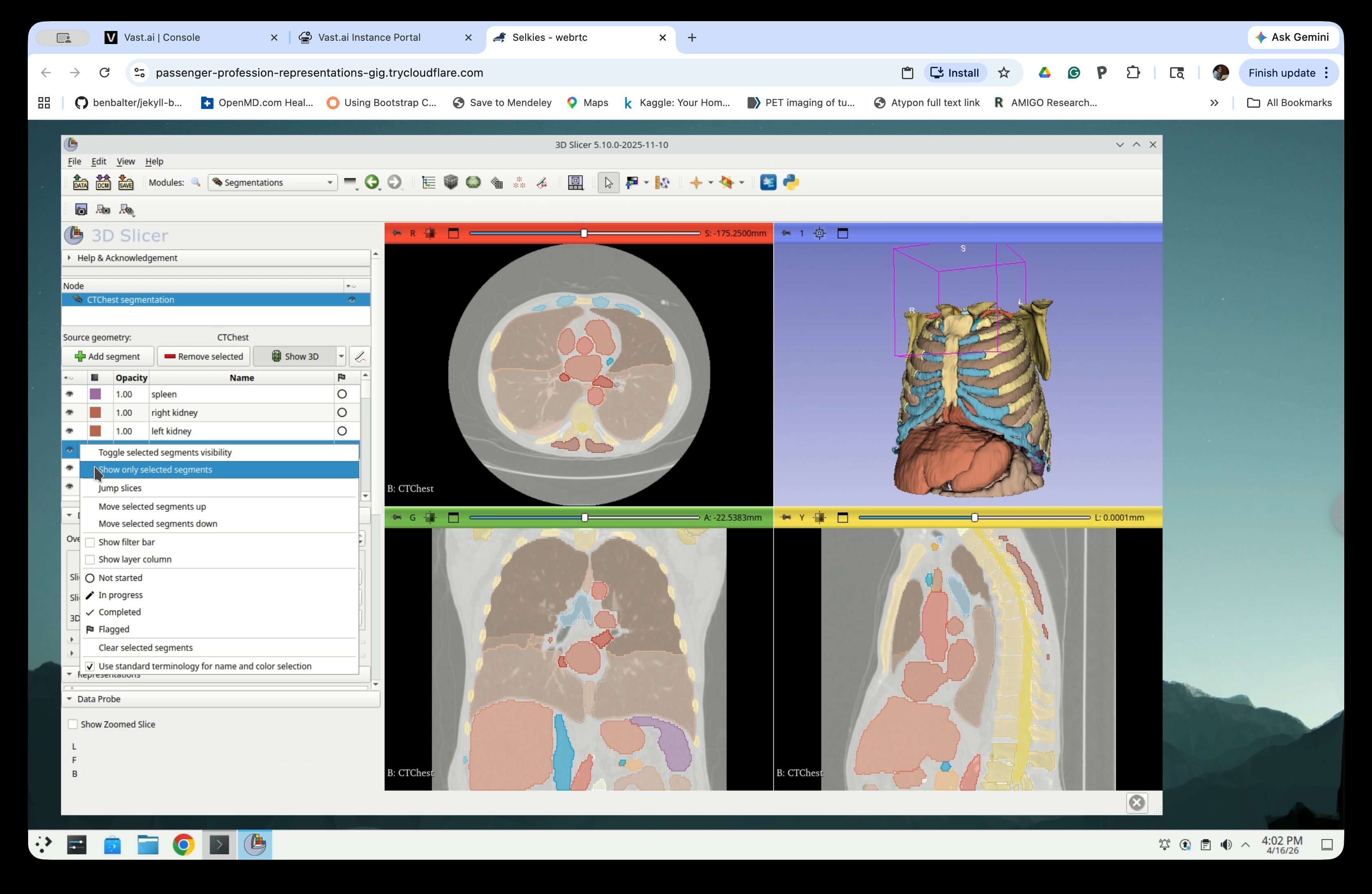 Segmentations panel with context menu showing Show only selected segments