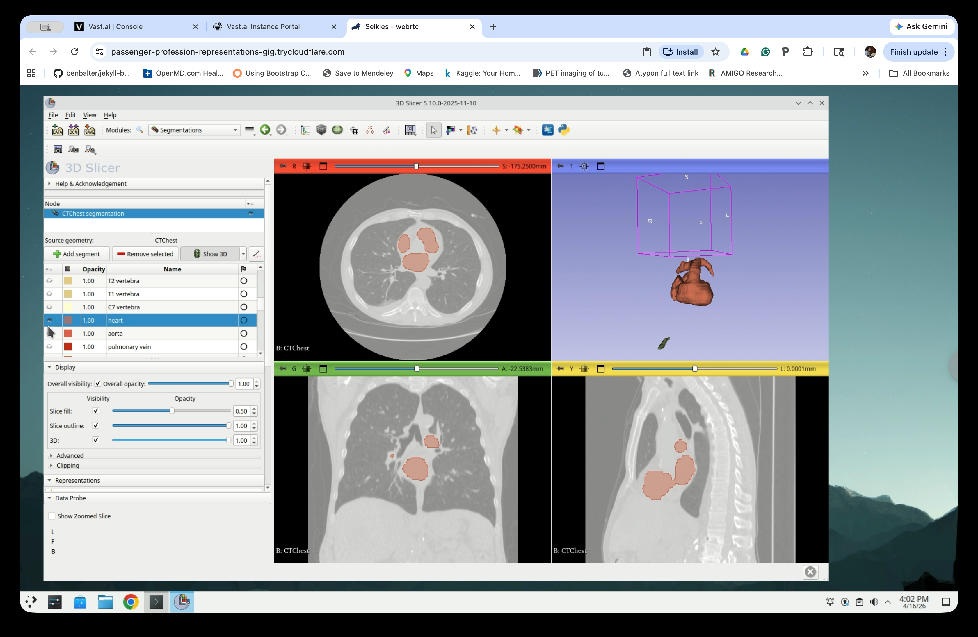 Segment list with heart selected and 3D view showing the heart