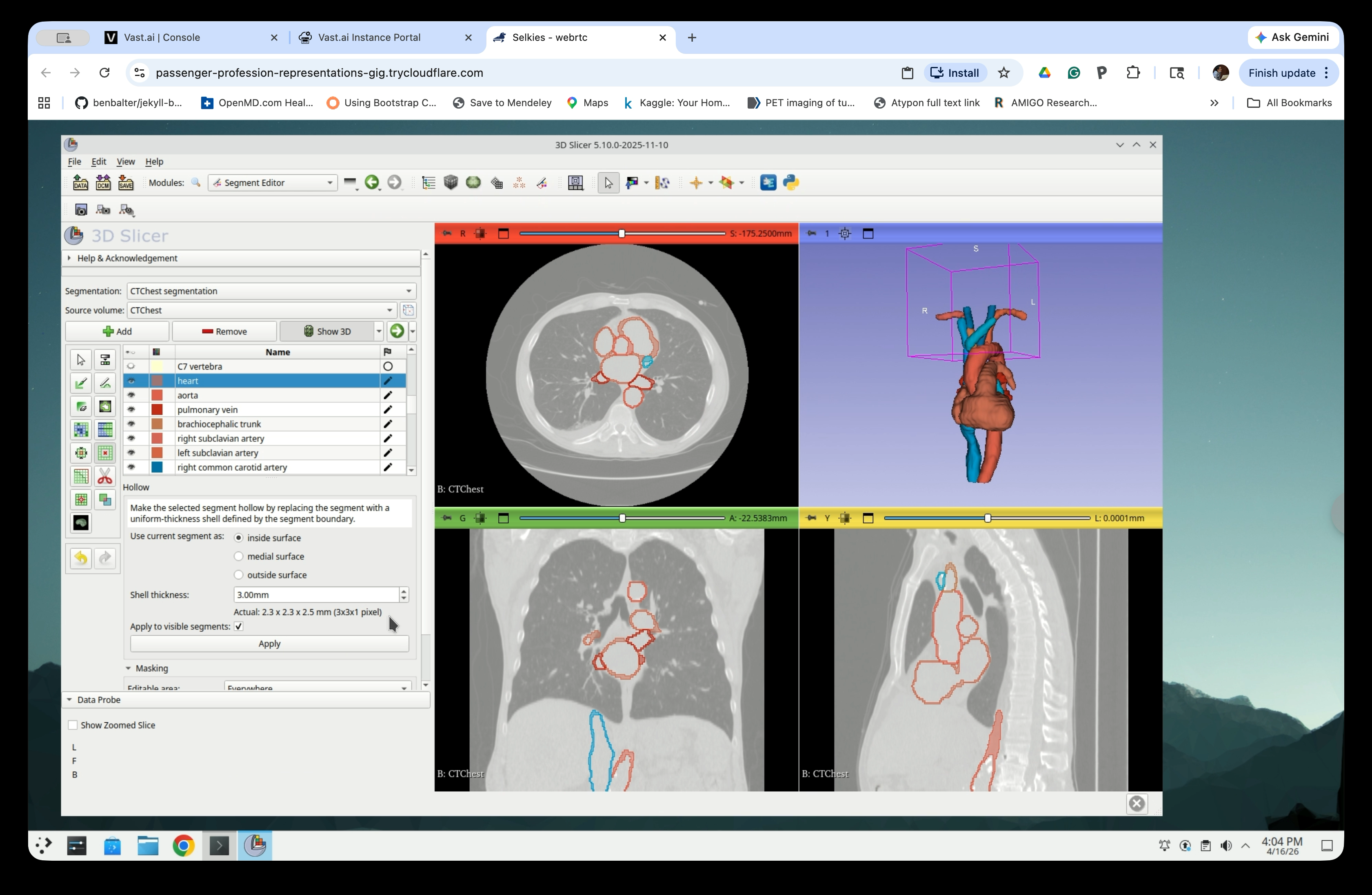 Slice views and 3D view showing hollowed heart and vessel segments