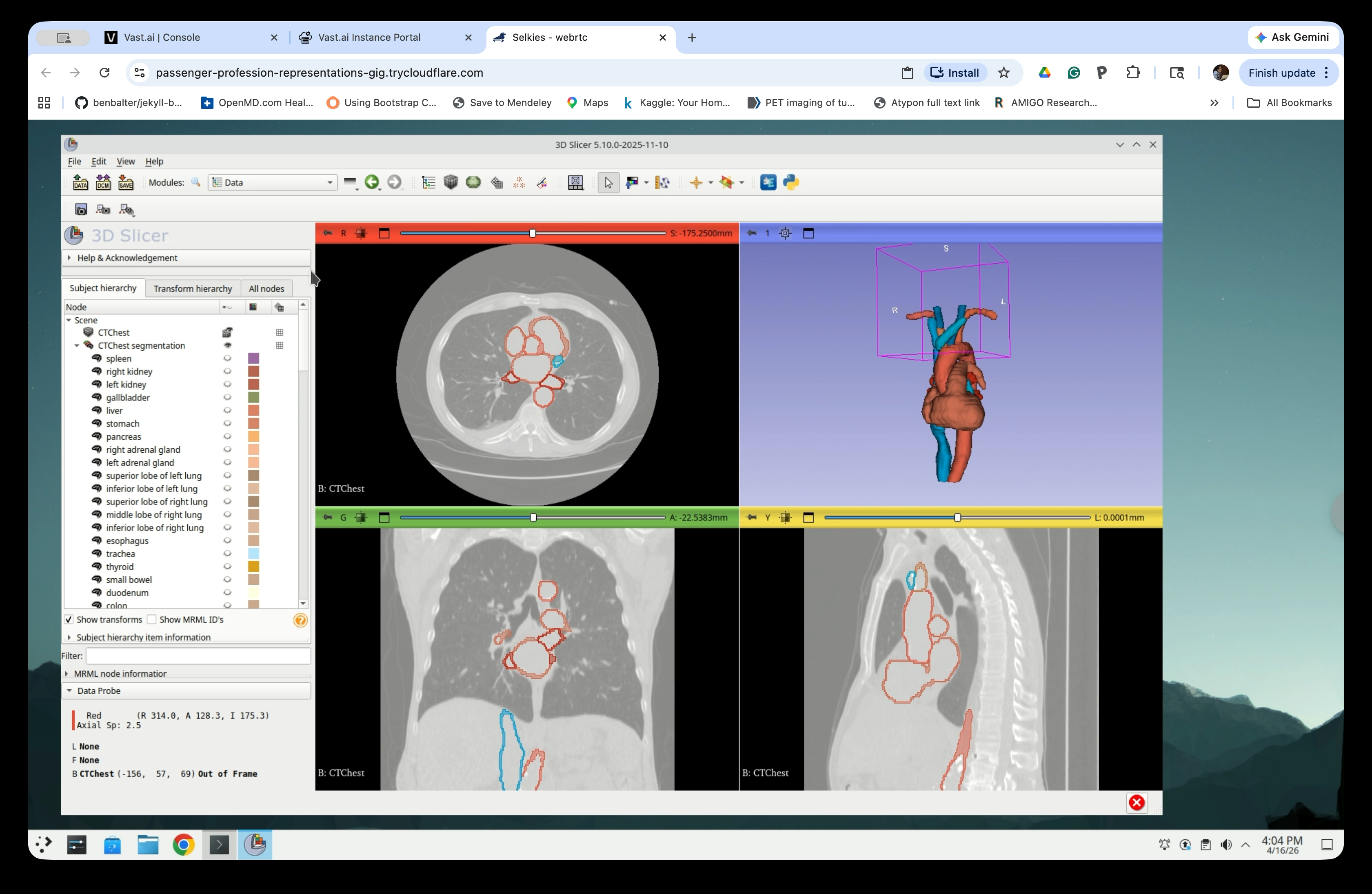 Data module scene tree showing CTChest, segmentation, and model nodes