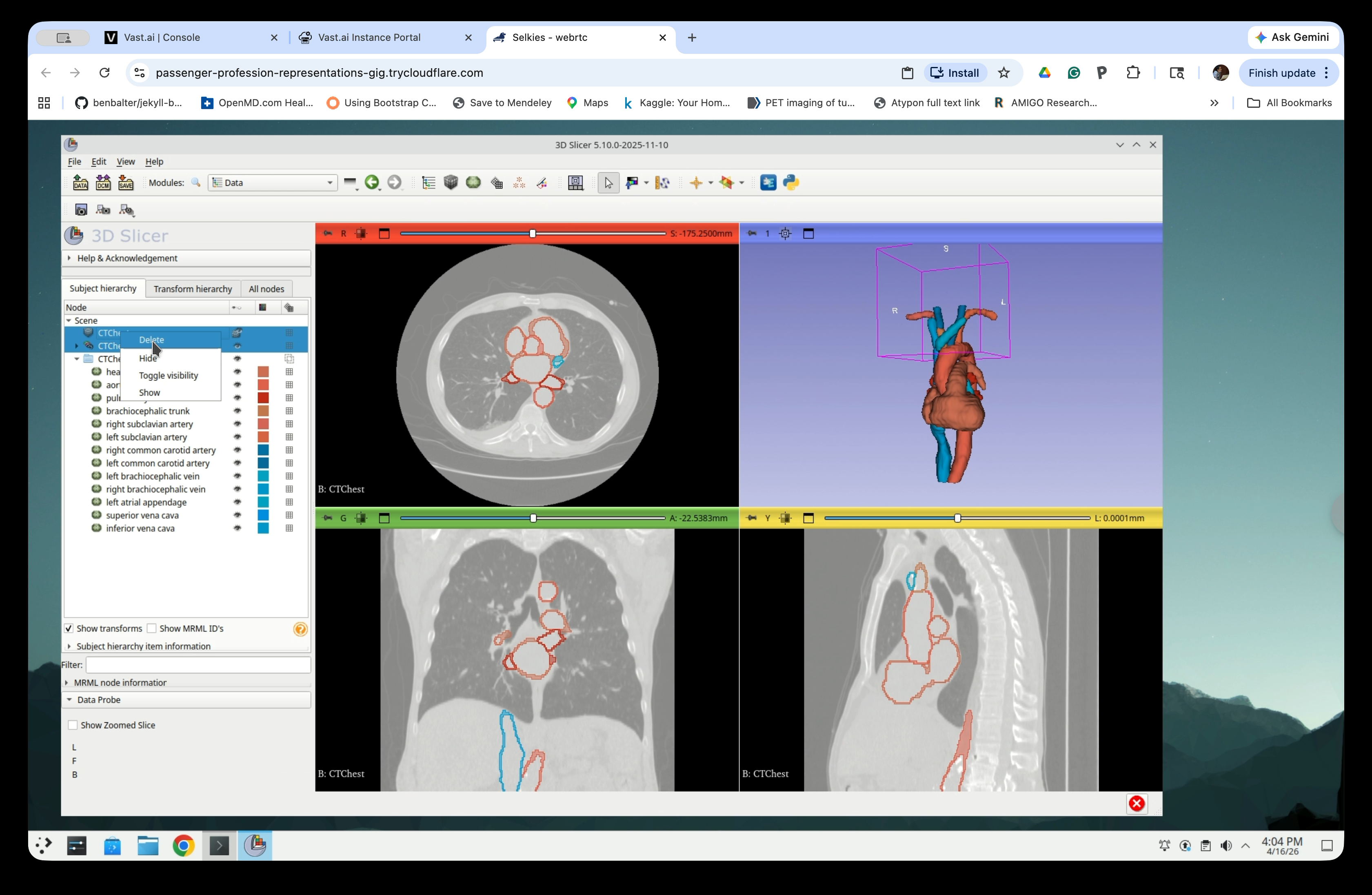 Right-click context menu on CTChest node showing Delete option