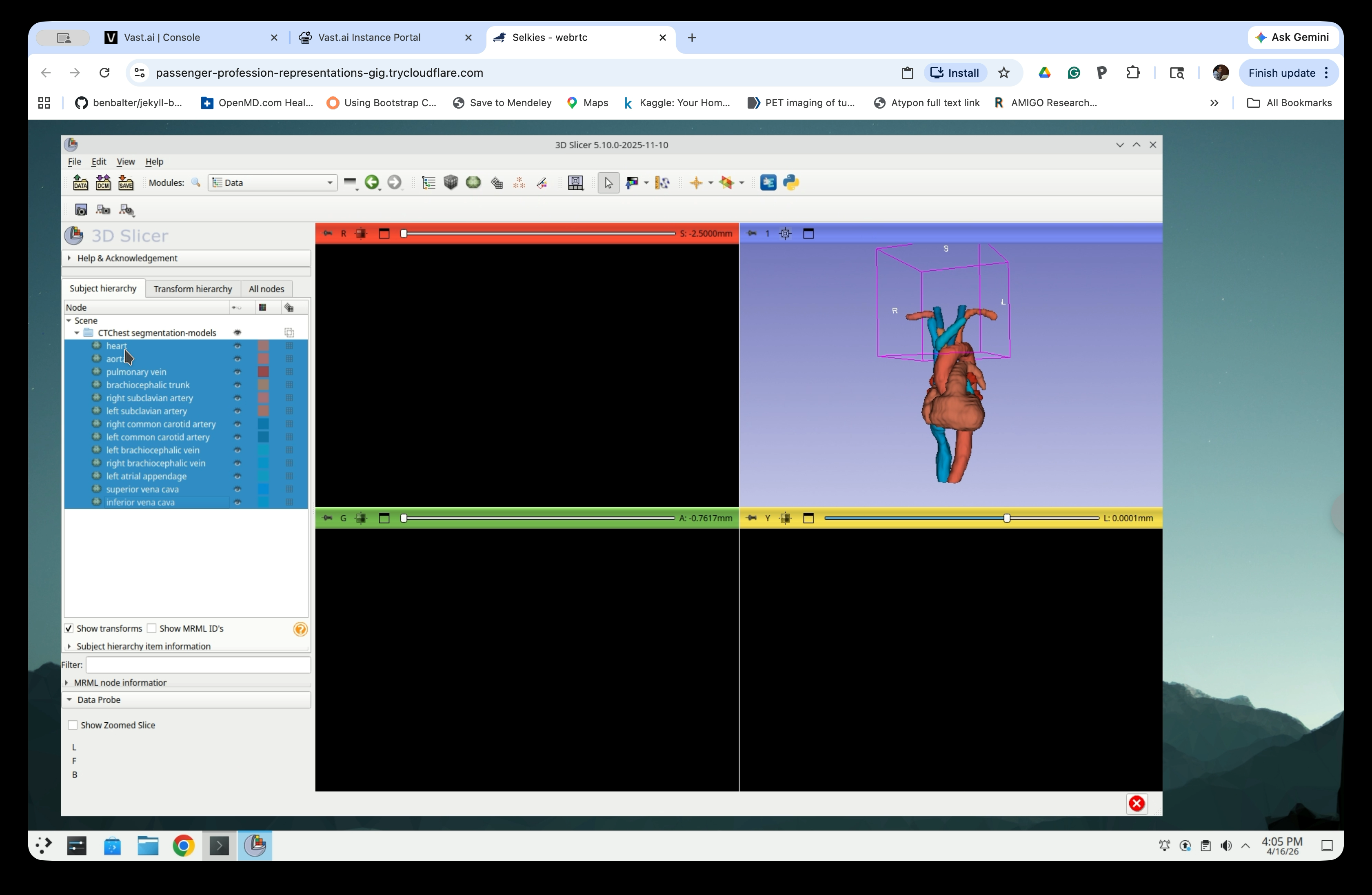 Scene tree showing only the CTChest segmentation-models folder and model nodes