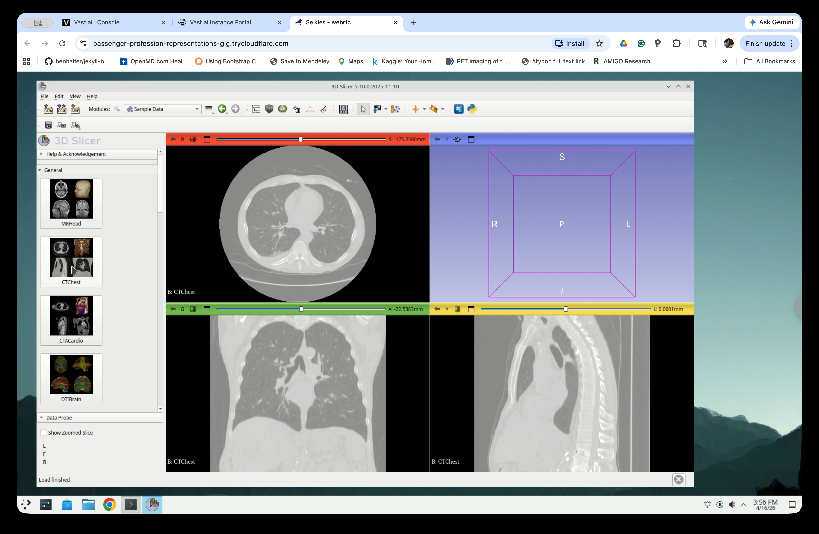 CTChest loaded in the three slice views