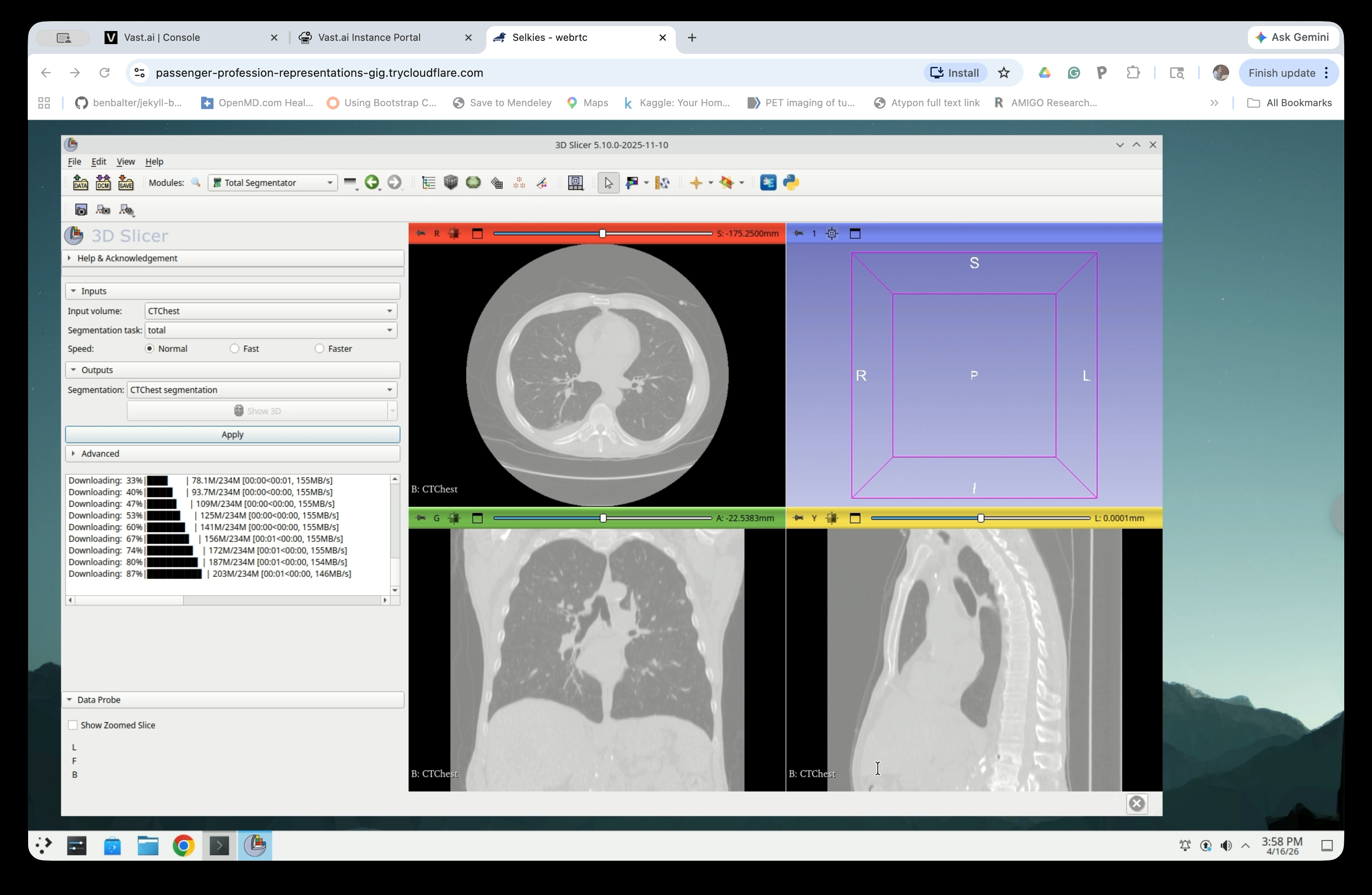 TotalSegmentator panel showing download progress percentages